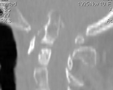 Superior Migration Ondontoid CT Sagittal